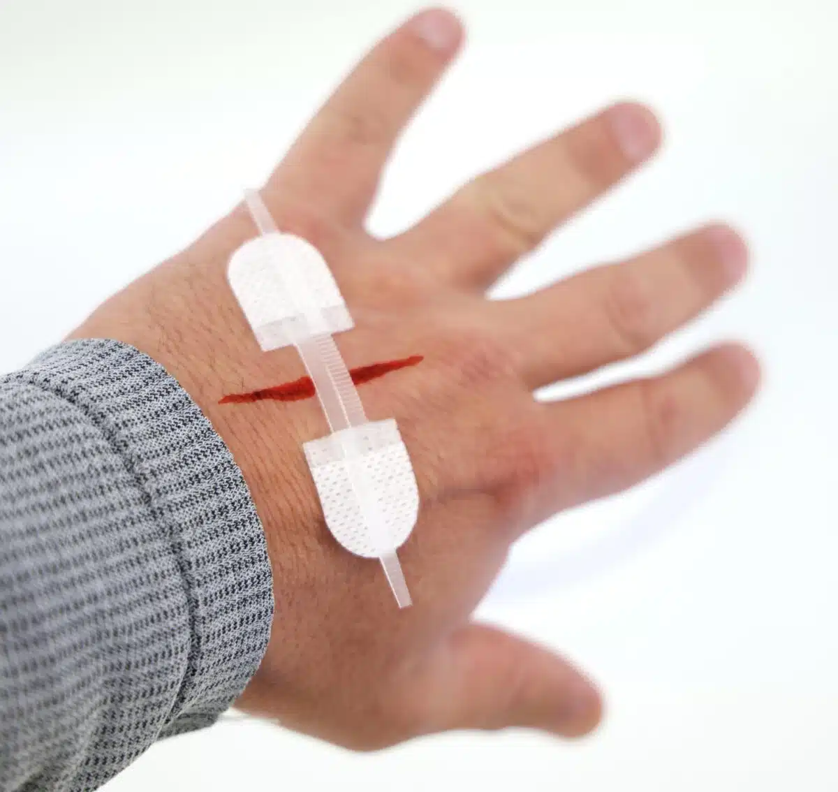 Med Pod | Zip Stitch Wound Closure Kit | LXSMK-ZIP - Image 6